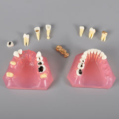 Dental Model with Caries Treatment and Other Cases