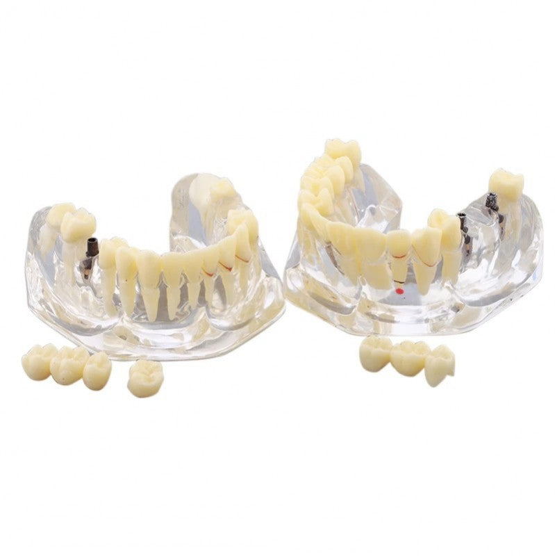 Dentarl Implant and Restoration Model, 2X Life-Size