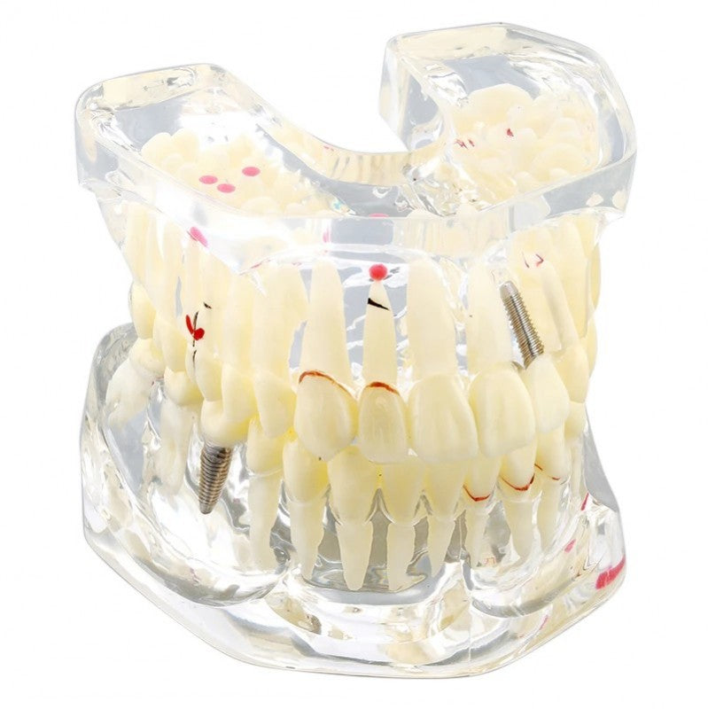 Dental Pathology Model for Demonstration, 2X Life-Size