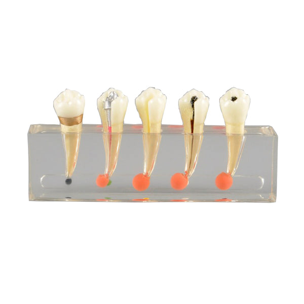 Dental Endodontic Treatment Model