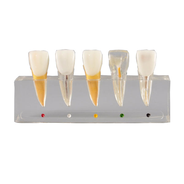 Dental Endodontic Treatment Model with Incisor