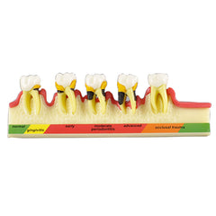 Dental State of Periodontal Disease Model