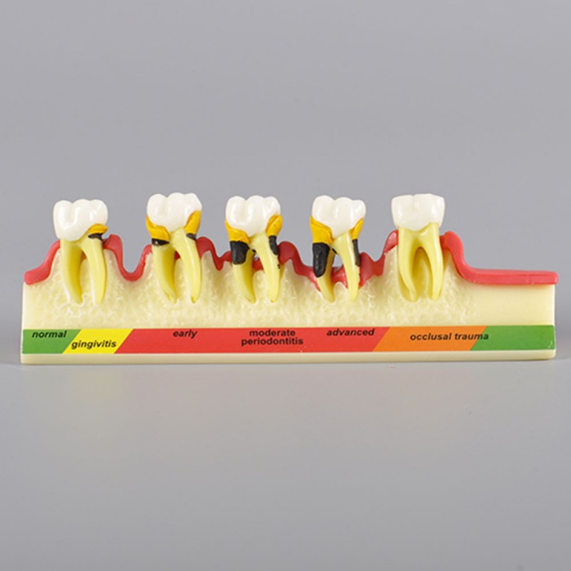 Dental State of Periodontal Disease Model