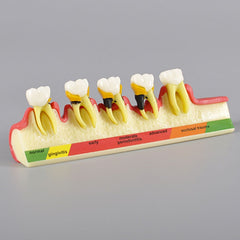 Dental State of Periodontal Disease Model