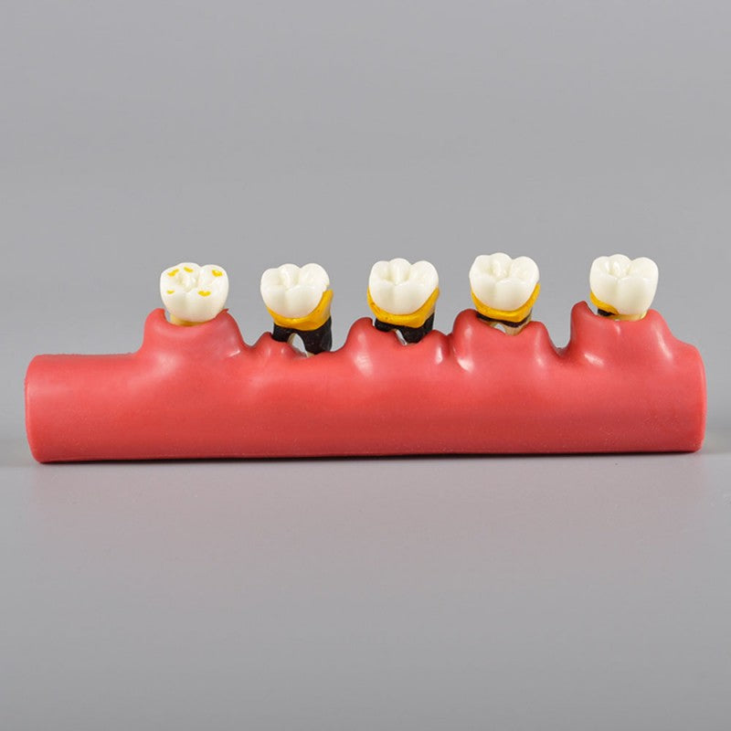 Dental State of Periodontal Disease Model