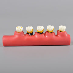 Dental State of Periodontal Disease Model