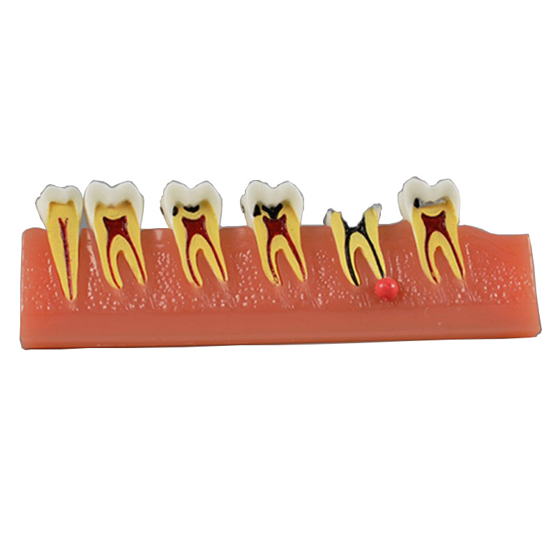 Dental Caries Illustration Model