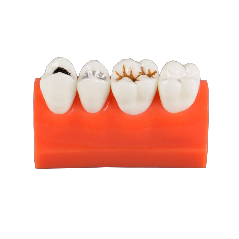 Dental Caries Model with Sealant and Inlay Demonstration