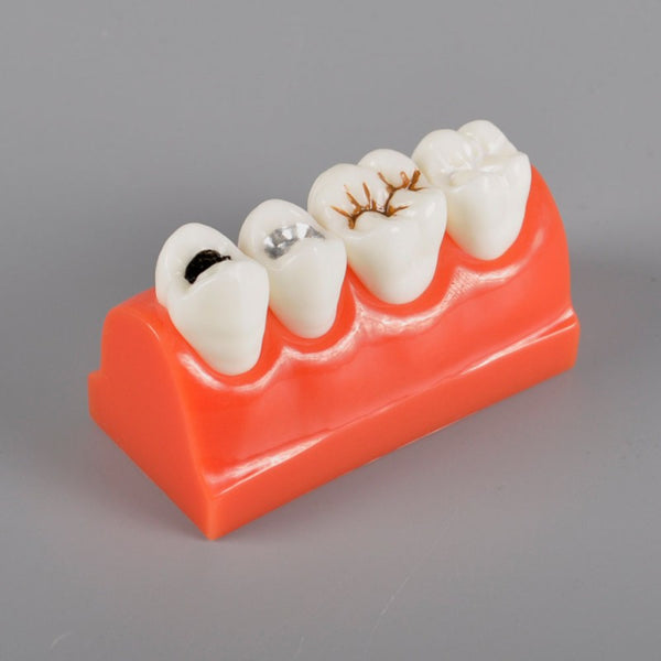 W4013 Dental Caries Model with Sealant and Inlay Demonstration – Dr ...