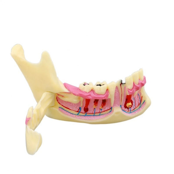 Dental Mandible Model with Caries
