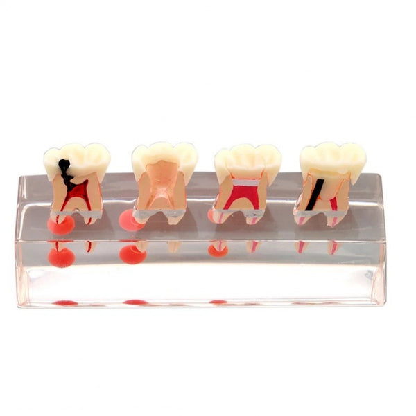 Dental Endodontic Treatment Model