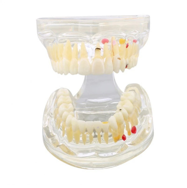 Dental Pathology Model with Different Cases
