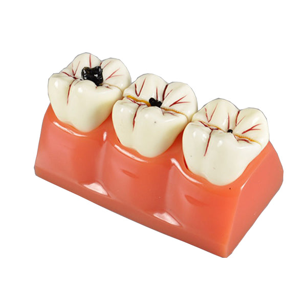 Dental Caries Model, 4X Life-Size, 7 Parts