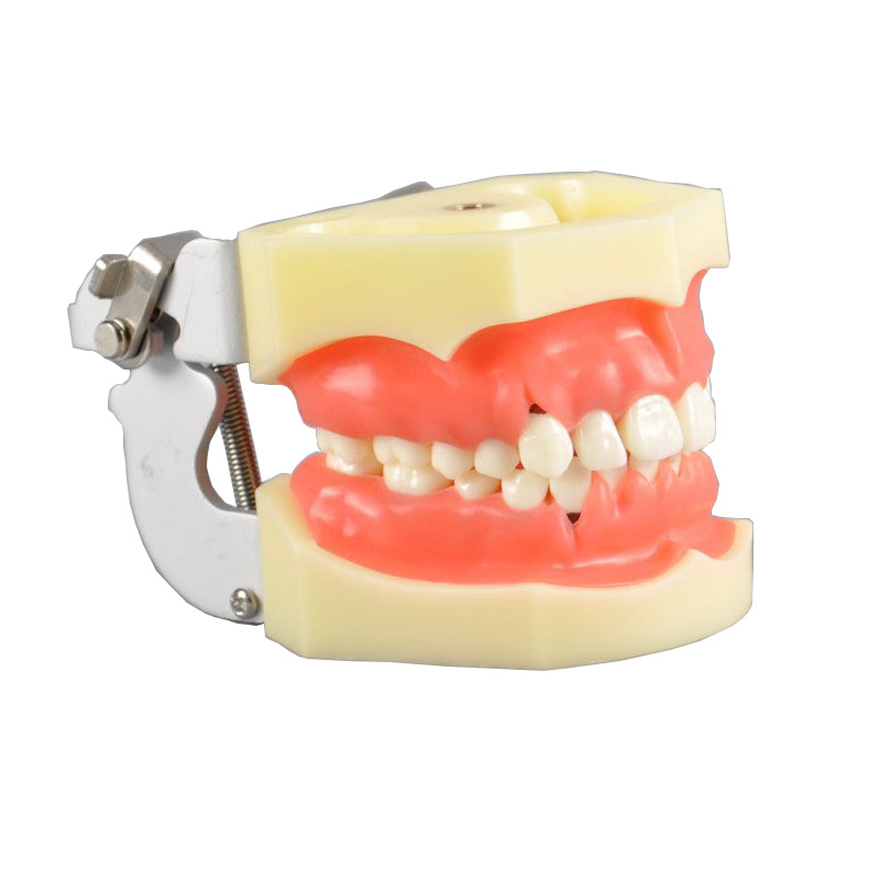 W4023 Dental Periodontal Model with Calculus and Gingivitis