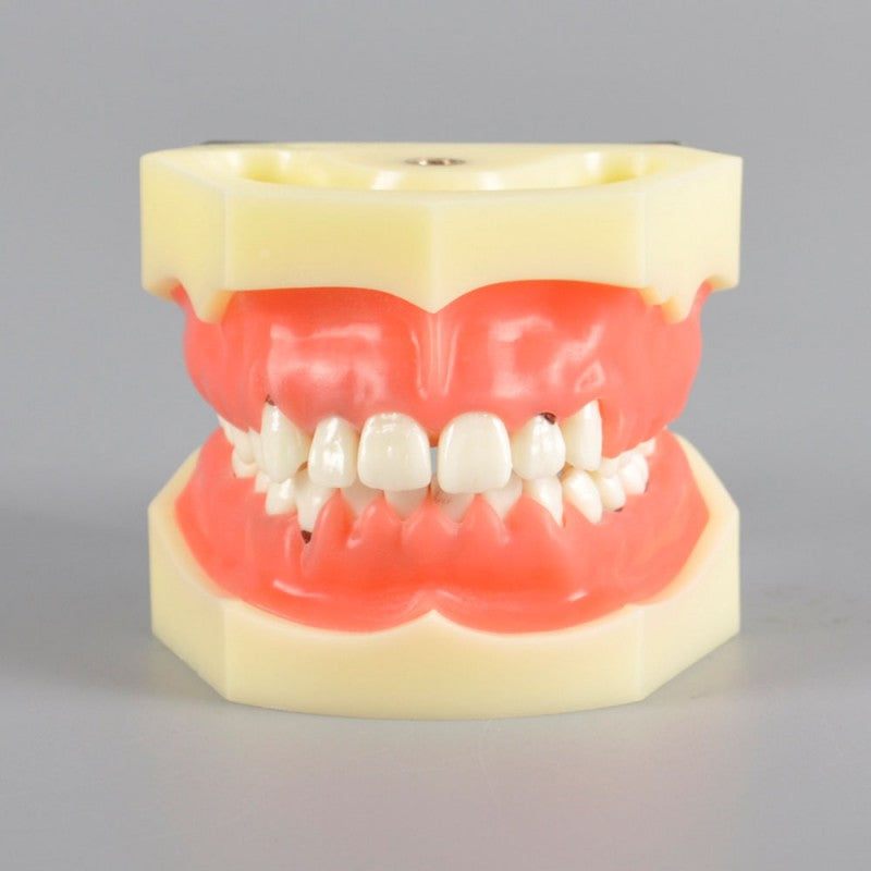 W4023 Dental Periodontal Model with Calculus and Gingivitis