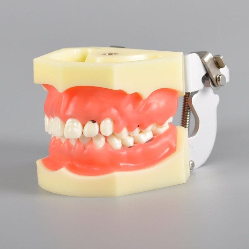 W4023 Dental Periodontal Model with Calculus and Gingivitis