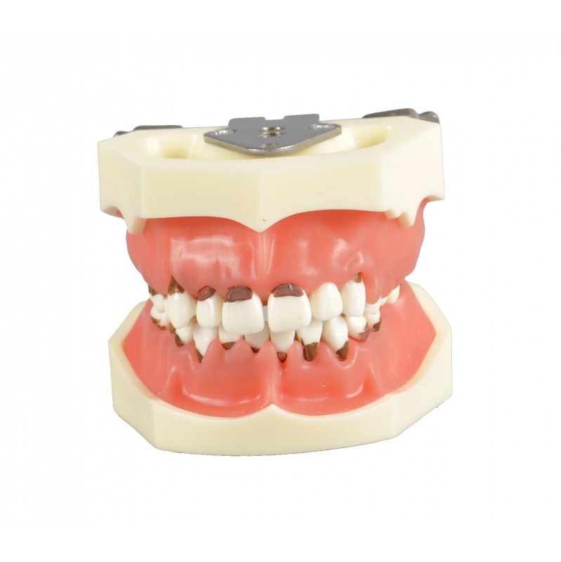 Dental Periodontal Model with 3 Cases