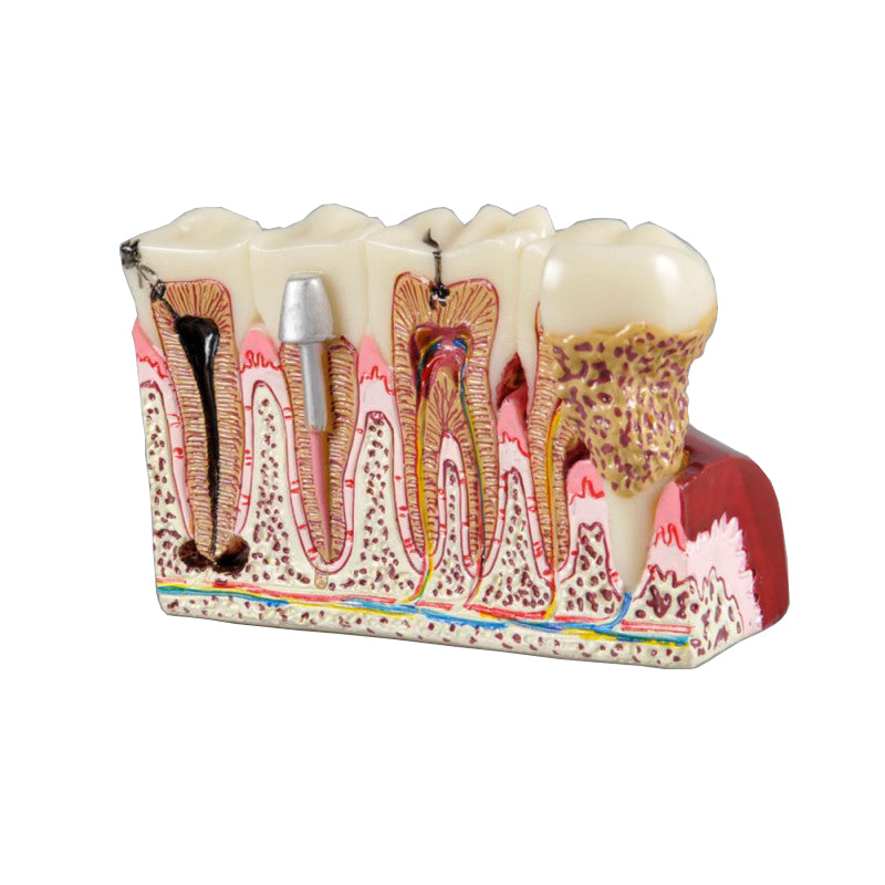 W4029 Dental Pathology Model with Kinds of Cases