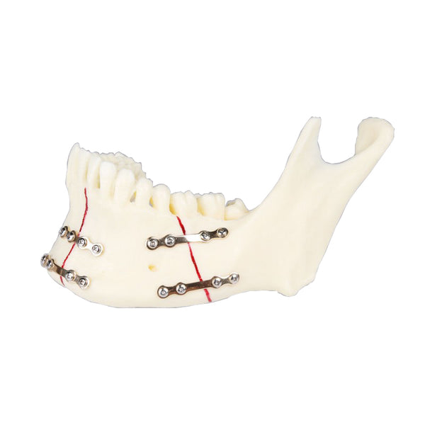  Jaw with Titanium Plate