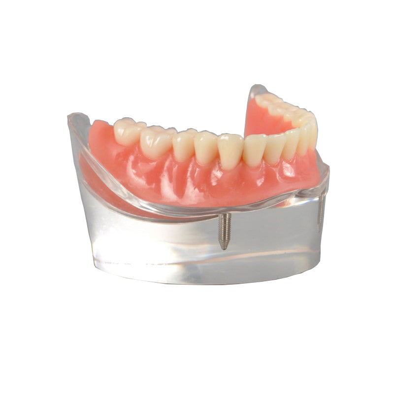 Dental Overdenture Model with 2 Implants