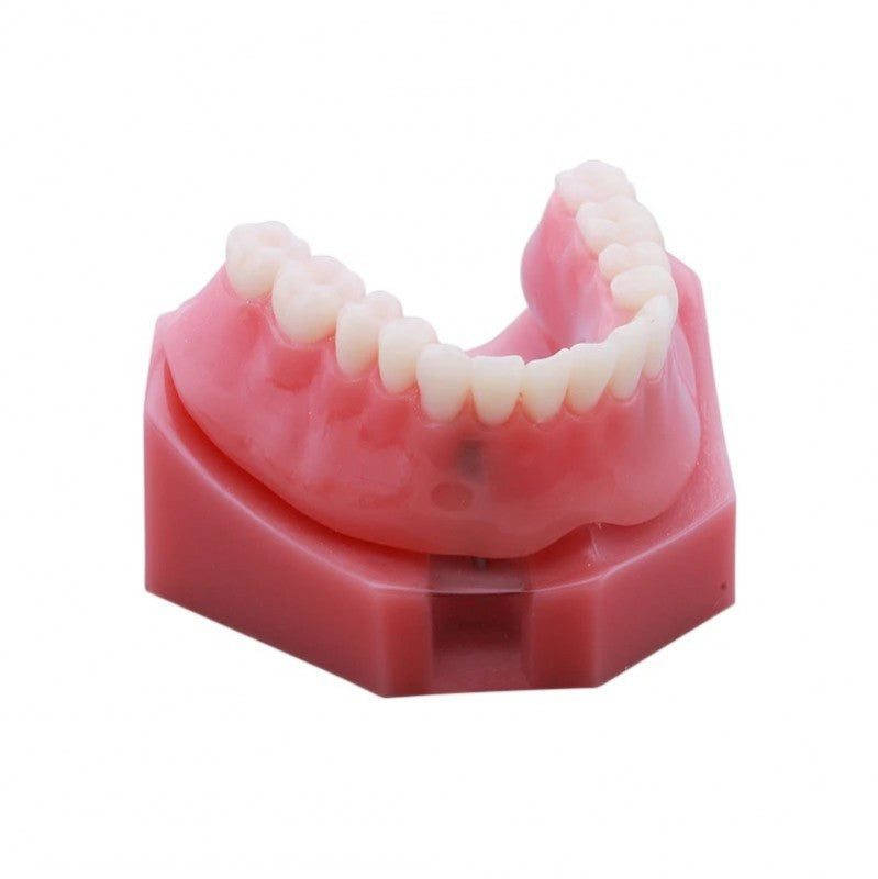 W6007 Overdenture Model with 2 Implants