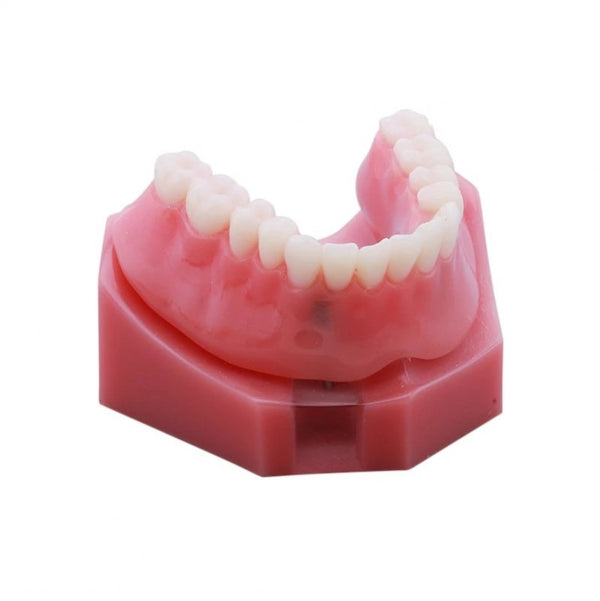 Dental Overdenture Model with 2 Implants