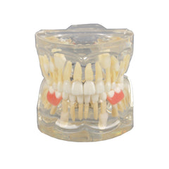 Mix Dentition Model with Removable Flipper