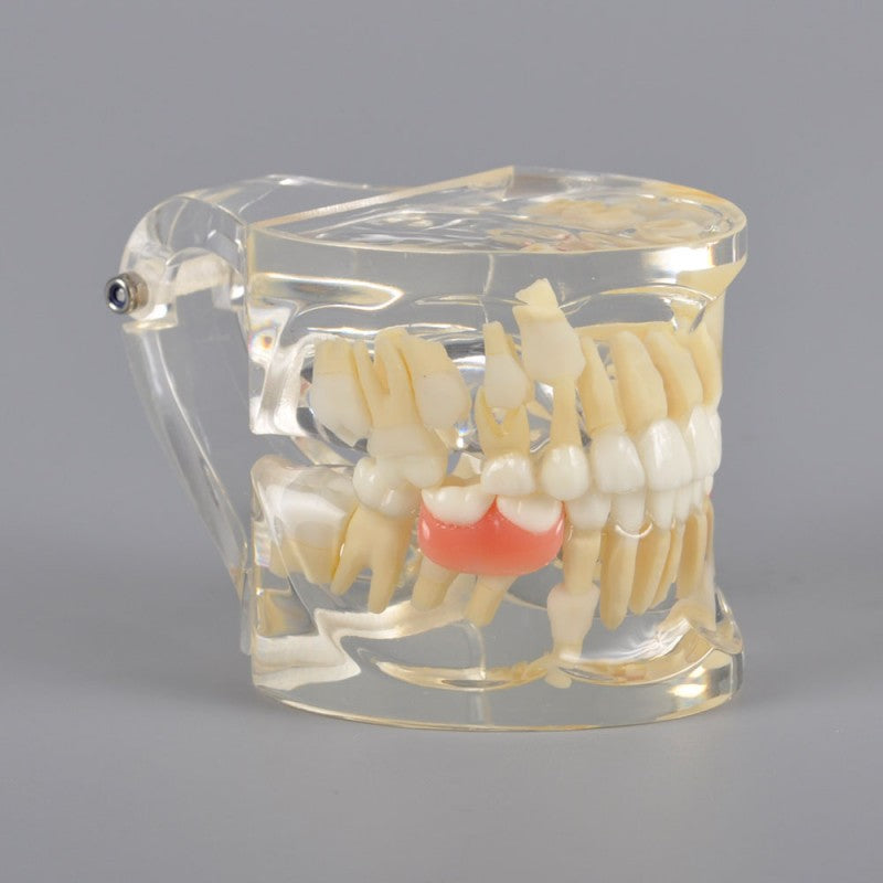 Mix Dentition Model with Removable Flipper