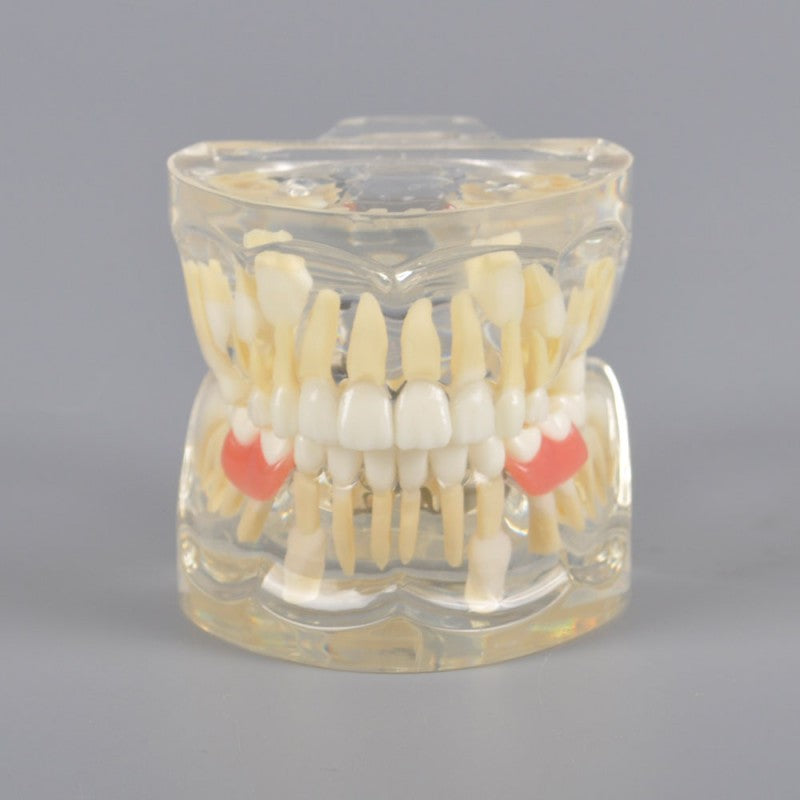 Mix Dentition Model with Removable Flipper