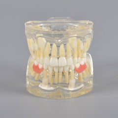 Mix Dentition Model with Removable Flipper