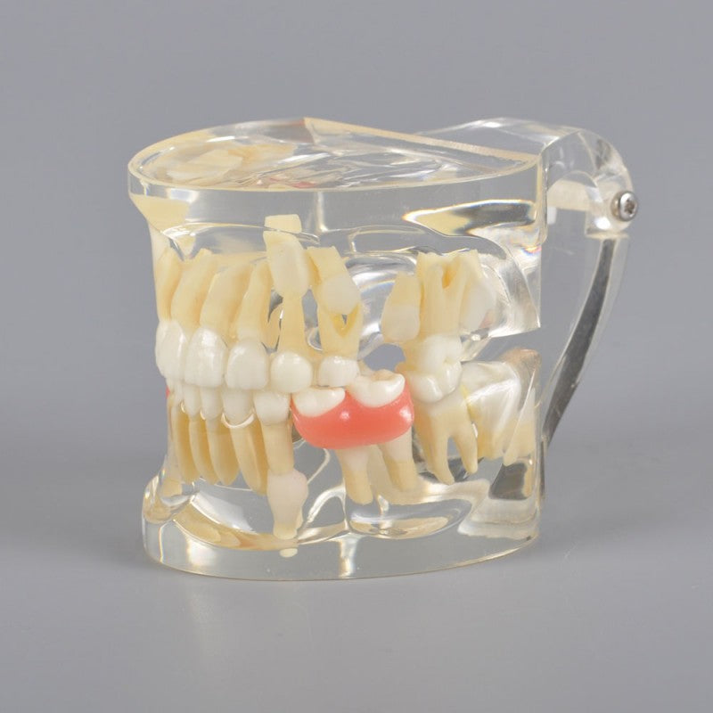 Mix Dentition Model with Removable Flipper