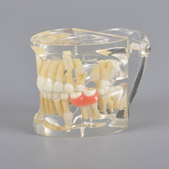 Mix Dentition Model with Removable Flipper