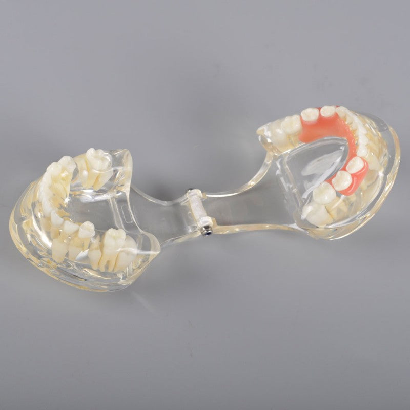 Mix Dentition Model with Removable Flipper