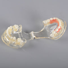 Mix Dentition Model with Removable Flipper