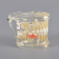 Mix Dentition Model with Removable Flipper