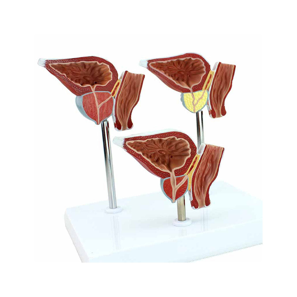 Prostate Scale Model Normal and Diseased Prostate Gland Model – Dr Wong Anatomy